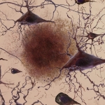 Objective Subtle Cognitive Difficulties Predict Amyloid Accumulation and Neurodegeneration