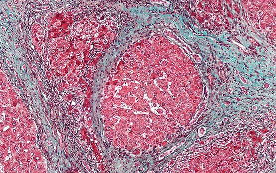 Scarring Cells Revert To Inactive State As Liver Heals