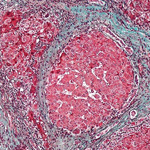 Scarring Cells Revert To Inactive State As Liver Heals