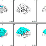 In Schizophrenia Patients, Auditory Cues Sound Bigger Problems