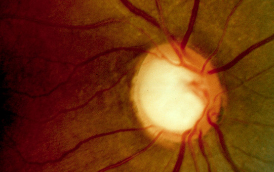 $6.4 Million Grant Funds Glaucoma Study in African-Americans