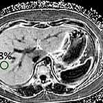 MRI Technique Developed for Nonalcoholic Fatty Liver Disease in Children