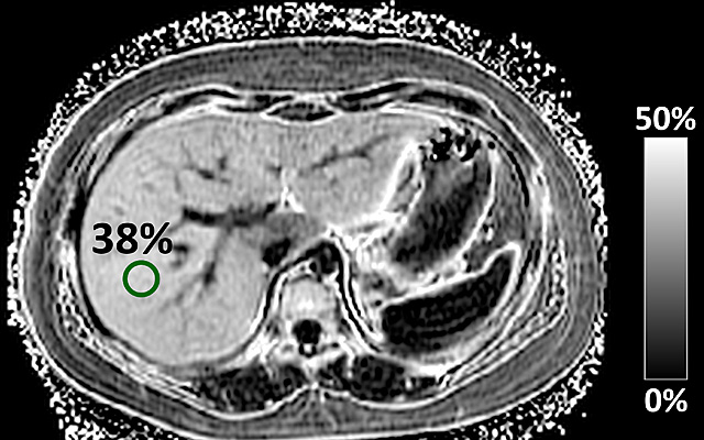 MRI Technique Developed for Nonalcoholic Fatty Liver Disease in Children