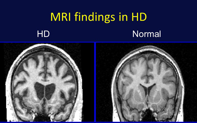 UC San Diego Health System Named Center of Excellence for Huntington’s Disease