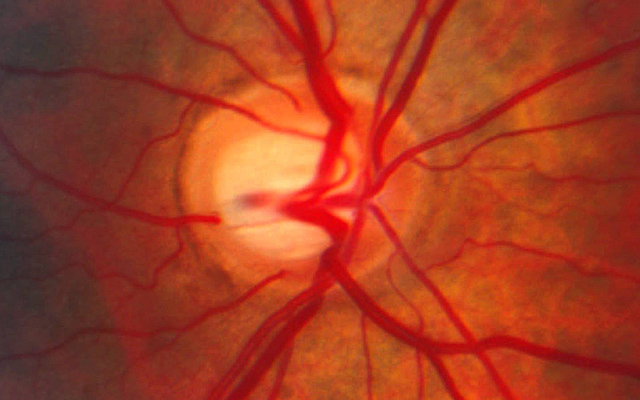 Identified Genetic Interaction Offers Possible New Target for Glaucoma Therapy