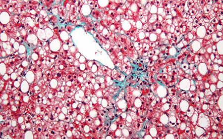 Technique May Identify Patients with Fast-Progressing Fibrosis in Nonalcoholic Fatty Liver Disease