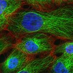 Predictive Proteins: Elevated Levels Trigger Metastatic Progression of Cancer Cells