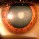 Stem Cells Regenerate Human Lens After Cataract Surgery, Restoring Vision