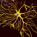 CIRM Grant to Fund Proposed Stem Cell Trials for ALS