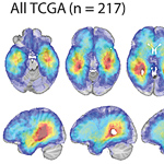 Clinical Study Suggests the Origin of Glioblastoma Subtypes