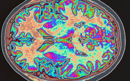 Image: Colorized magnetic resonance image of human brain.