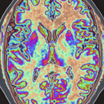 Current Screening Methods Miss Worrisome Number of Persons with Mild Cognitive Impairment