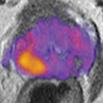 Imaging Biomarker Distinguishes Prostate Cancer Tumor Grade