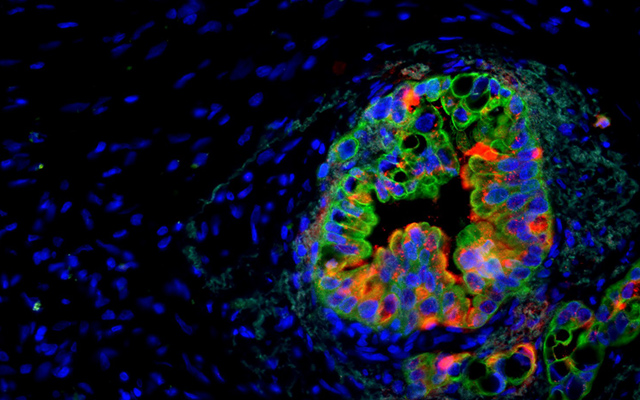 Novel Imaging Model Helps Reveal New Therapeutic Target for Pancreatic Cancer