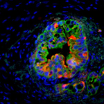 Novel Imaging Model Helps Reveal New Therapeutic Target for Pancreatic Cancer