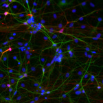 Mini-brain Model of Idiopathic Autism Reveals Underlying Pathology of Neuronal Overgrowth