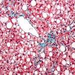 Technique May Identify Patients with Fast-Progressing Fibrosis in Nonalcoholic Fatty Liver Disease