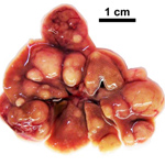 Unexpected Activity of Two Enzymes Helps Explain Why Liver Cancer Drugs Fail