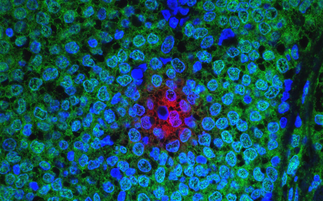 Cancer Cells Send Signals Boosting Survival and Drug Resistance in Other Cancer Cells