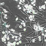 In Multiple Myeloma, High Levels of Enzyme ADAR1 are Associated with Reduced Survival