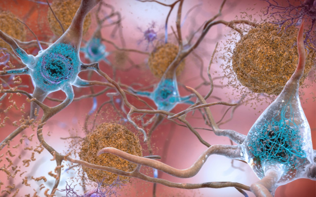 Researchers Map Protein-Gene Interactions Involved in Alzheimer’s Disease