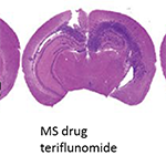 Adding MS Drug to Targeted Cancer Therapy May Improve Glioblastoma Outcomes