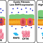 Modifier Gene May Explain Why Some with Cystic Fibrosis are Less Prone to Infection