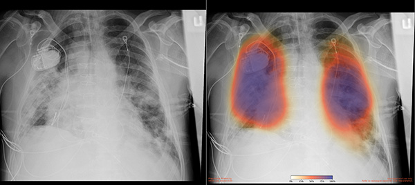 Chest X-ray for patient with COVID-19