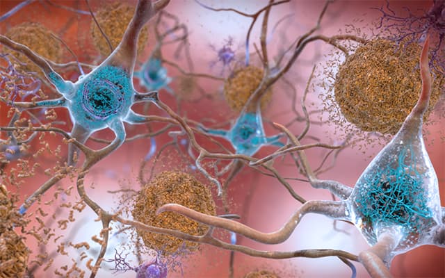 Novel Drug Prevents Amyloid Plaques, a Hallmark of Alzheimer’s Disease