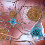 Novel Drug Prevents Amyloid Plaques, a Hallmark of Alzheimer’s Disease