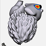 Remapping Atrial Fibrillation Treatment