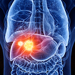 Causes of Liver Cancer are Changing Around the World: Some Up, Some Down