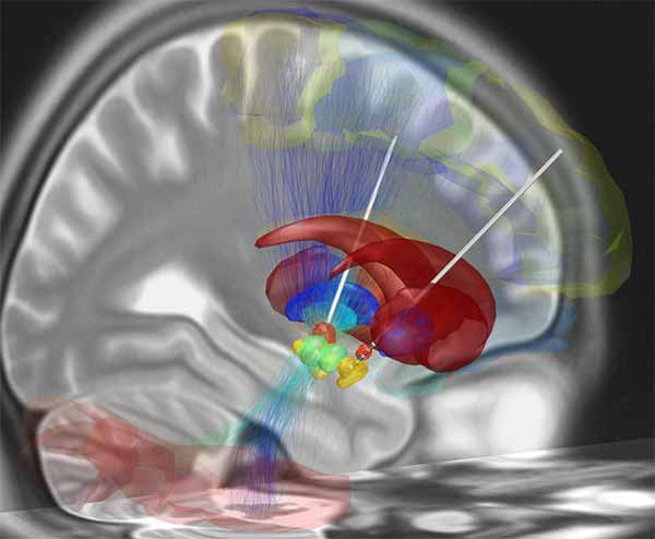 Image: A reconstruction of deep brain stimulation electrodes that have been surgically placed into the most common target structure for treatment of Parkinson’s disease
