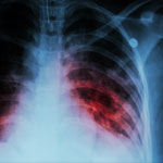 Supercomputer Simulations Help Combat Tuberculosis (TB) Granulomas