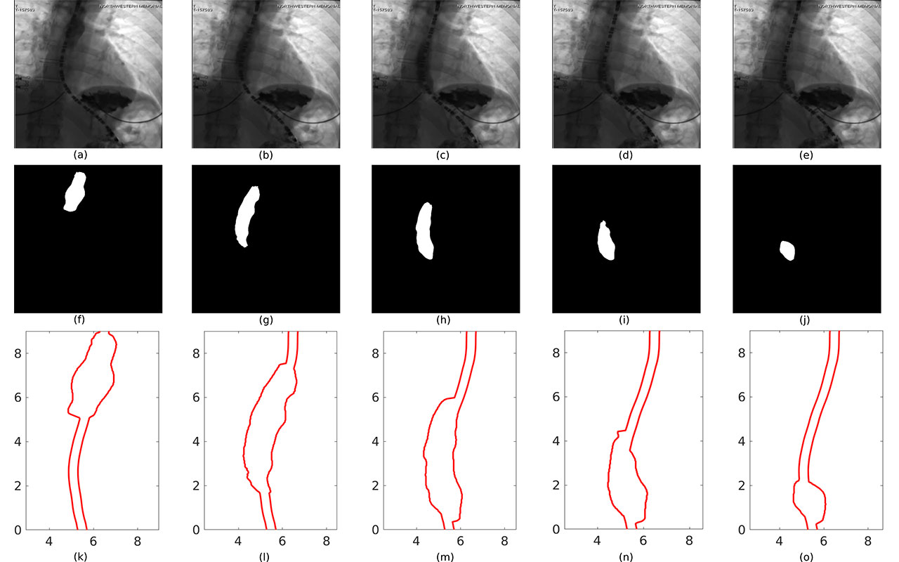 Supercomputer-Generated Models Provide Better Understanding of Esophageal Disorders