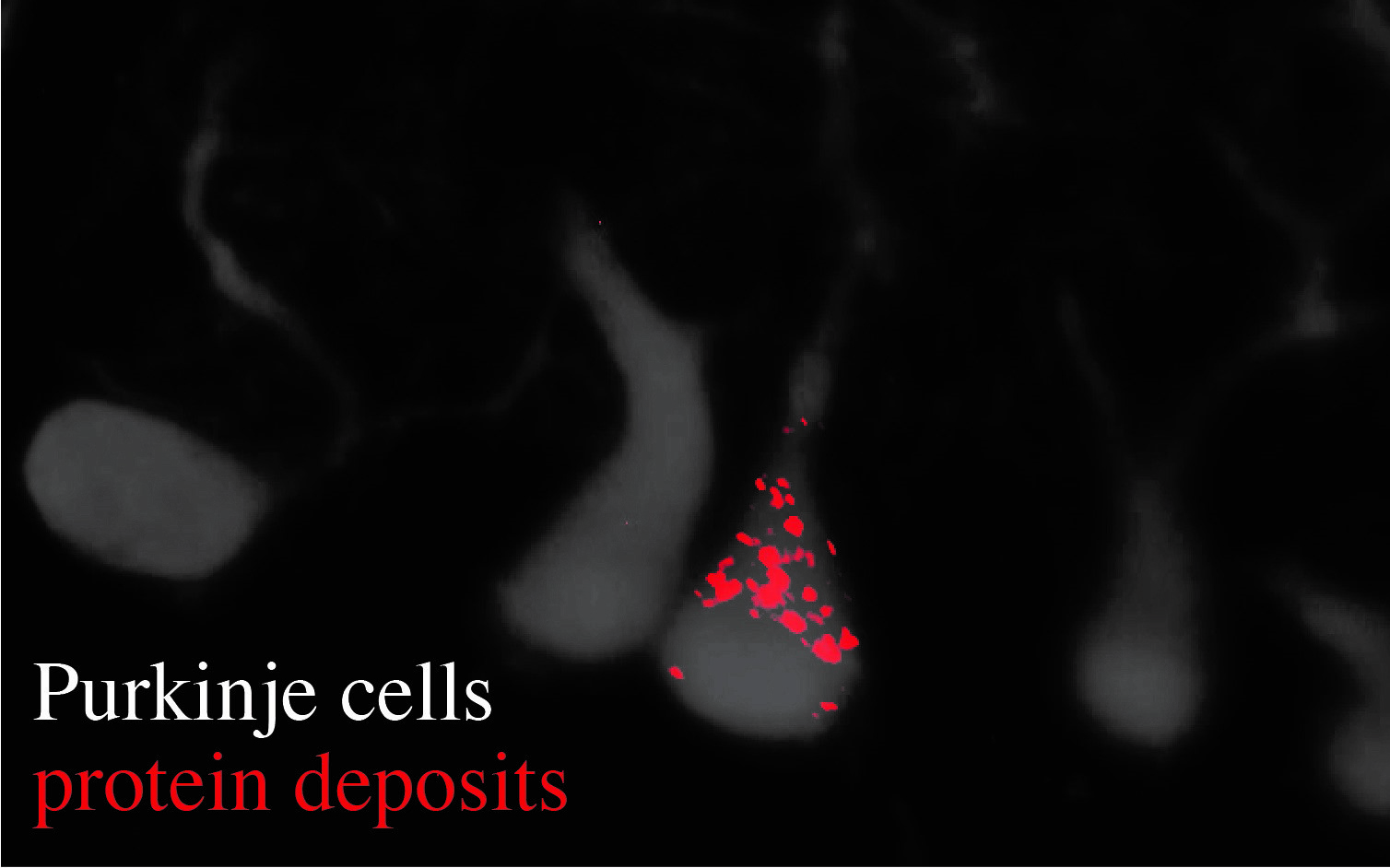Microscopic image shows Purkinje cells and an accumulation of protein deposits.