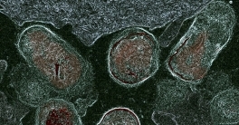 Breaking Down Barriers: What Happens When the Vaginal Microbiome Attacks