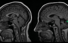 Patients with spinocerebellar ataxia type 14 display cerebellar atrophy (right, green arrow) compared to age-matched healthy controls (left).