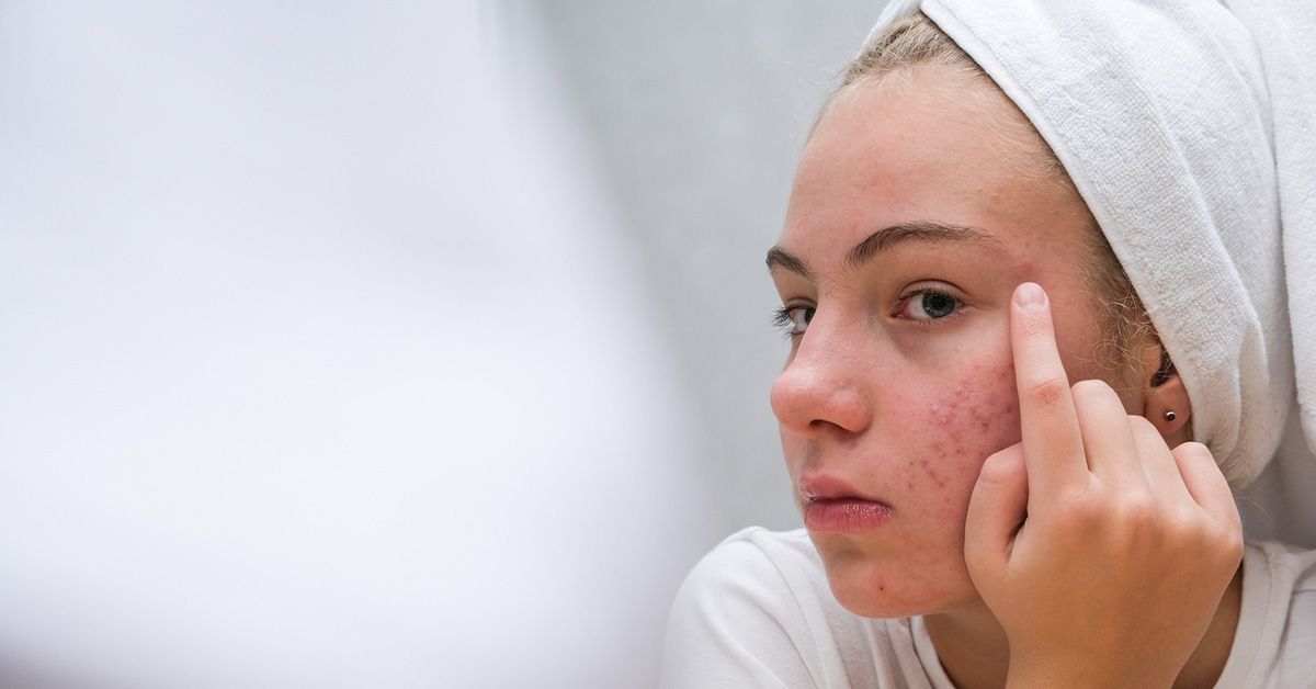 Groundbreaking Research Paves the Way for Acne Vaccine