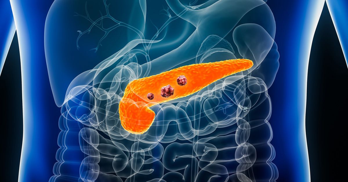 膵臓がんの腫瘍増殖と転移を促進する酵素が同定される(Enzyme Promoting Tumor Growth and Spread in Pancreatic Cancer Identified)