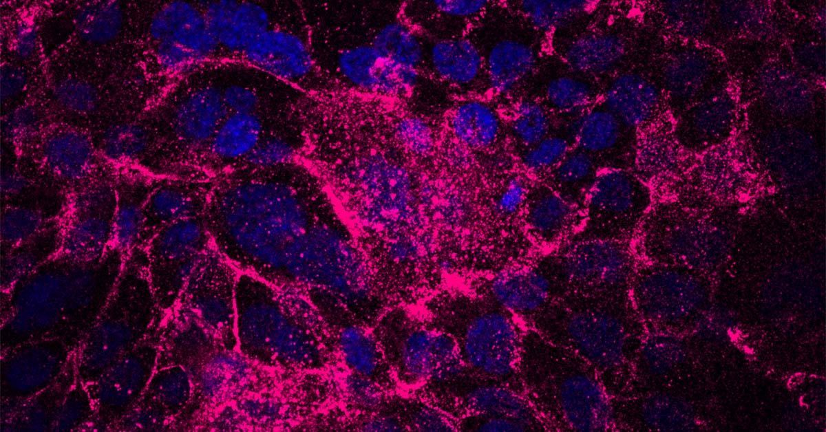 Stress-resistant cells promote tumorigenesis in pancreatic cancer