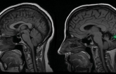‘Leaky’ Activity of Mutated Enzyme Underlies Neurodegenerative Disease