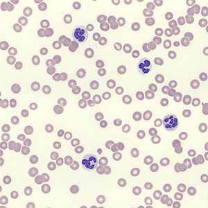 Cancer-associated Mutations are Common in Patients with Unexplained Low Blood Counts