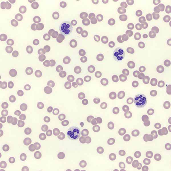Image: Abnormal red blood cells are easily spotted among healthy cells.