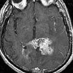 Old Drugs Find New Target For Treating Brain Tumor