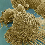 UC San Diego Cancer Researchers Receive $4 Million CIRM Disease-Team Grant