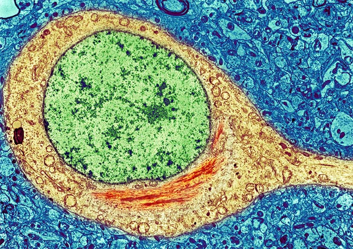 human neuron with tau tangles