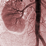 Urine Biomarkers Reveal Mitochondrial Dysfunction in Diabetic Kidney Disease