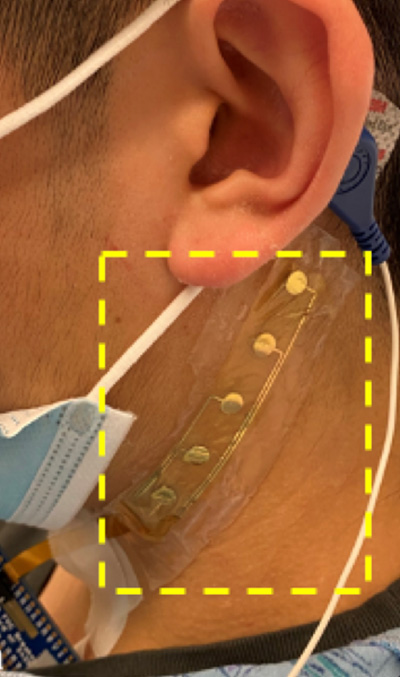 cervical nervus  monitor