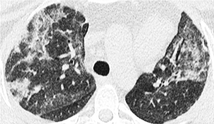 graphic of lungs in black and white